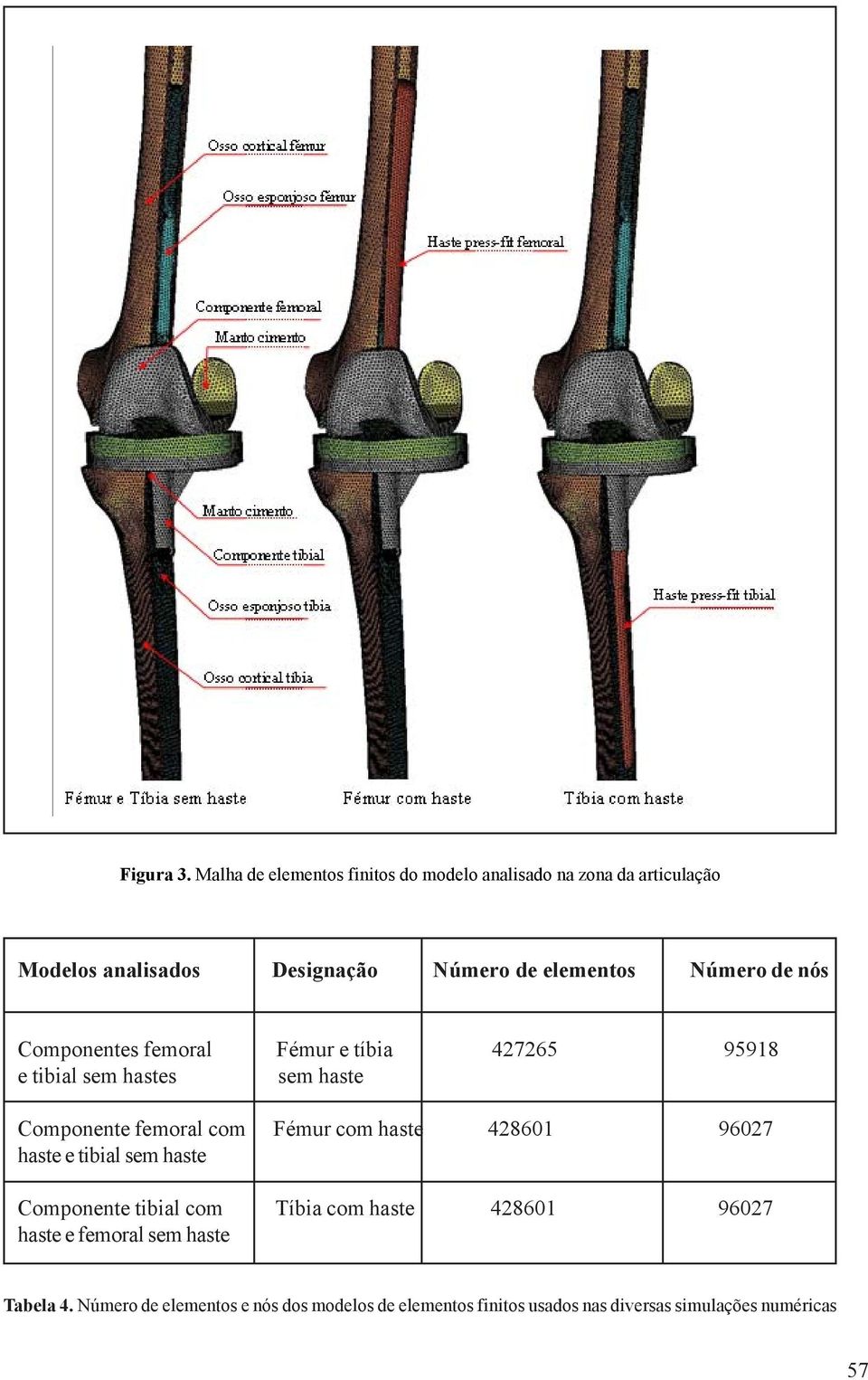 Número de nós Componentes femoral Fémur e tíbia 427265 95918 e tibial sem hastes sem haste Componente femoral com Fémur