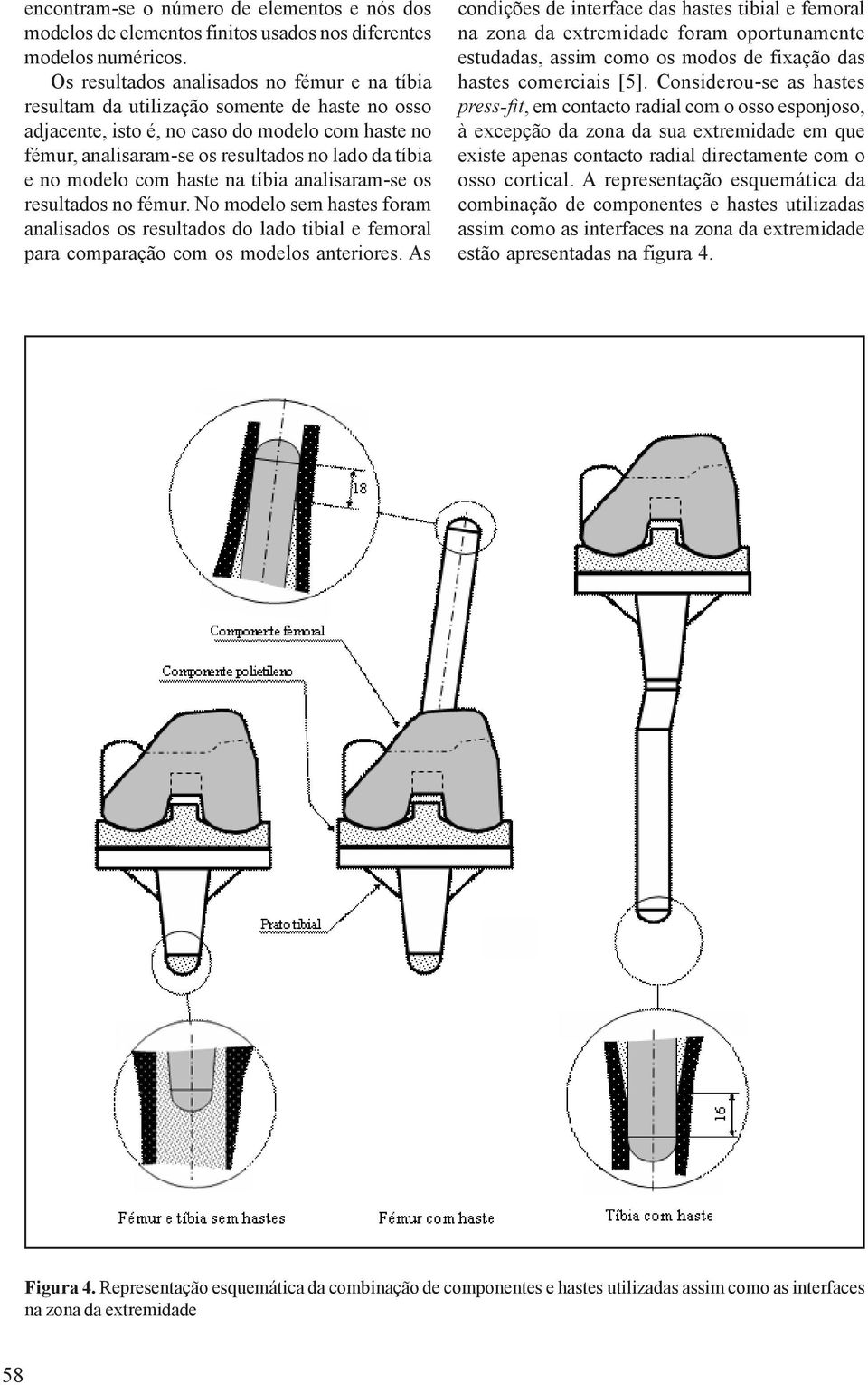 modelo com haste na tíbia analisaram-se os resultados no fémur. No modelo sem hastes foram analisados os resultados do lado tibial e femoral para comparação com os modelos anteriores.