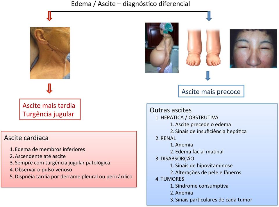 Dispnéia tardia por derrame pleural ou pericárdico Outras ascites 1. HEPÁTICA / OBSTRUTIVA 1. Ascite precede o edema 2.