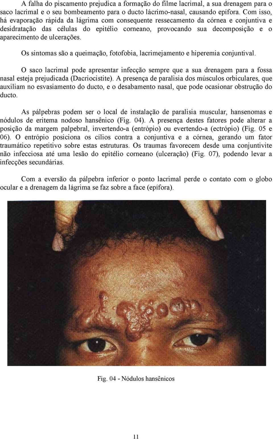 ulcerações. Os sintomas são a queimação, fotofobia, lacrimejamento e hiperemia conjuntival.