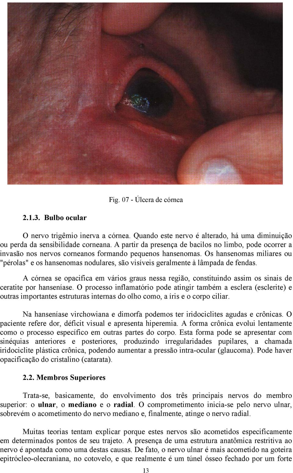 Os hansenomas miliares ou "pérolas" e os hansenomas nodulares, são visíveis geralmente à lâmpada de fendas.