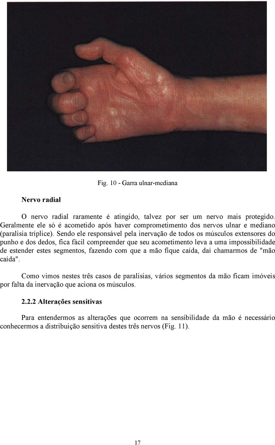 Sendo ele responsável pela inervação de todos os músculos extensores do punho e dos dedos, fica fácil compreender que seu acometimento leva a uma impossibilidade de estender estes segmentos,