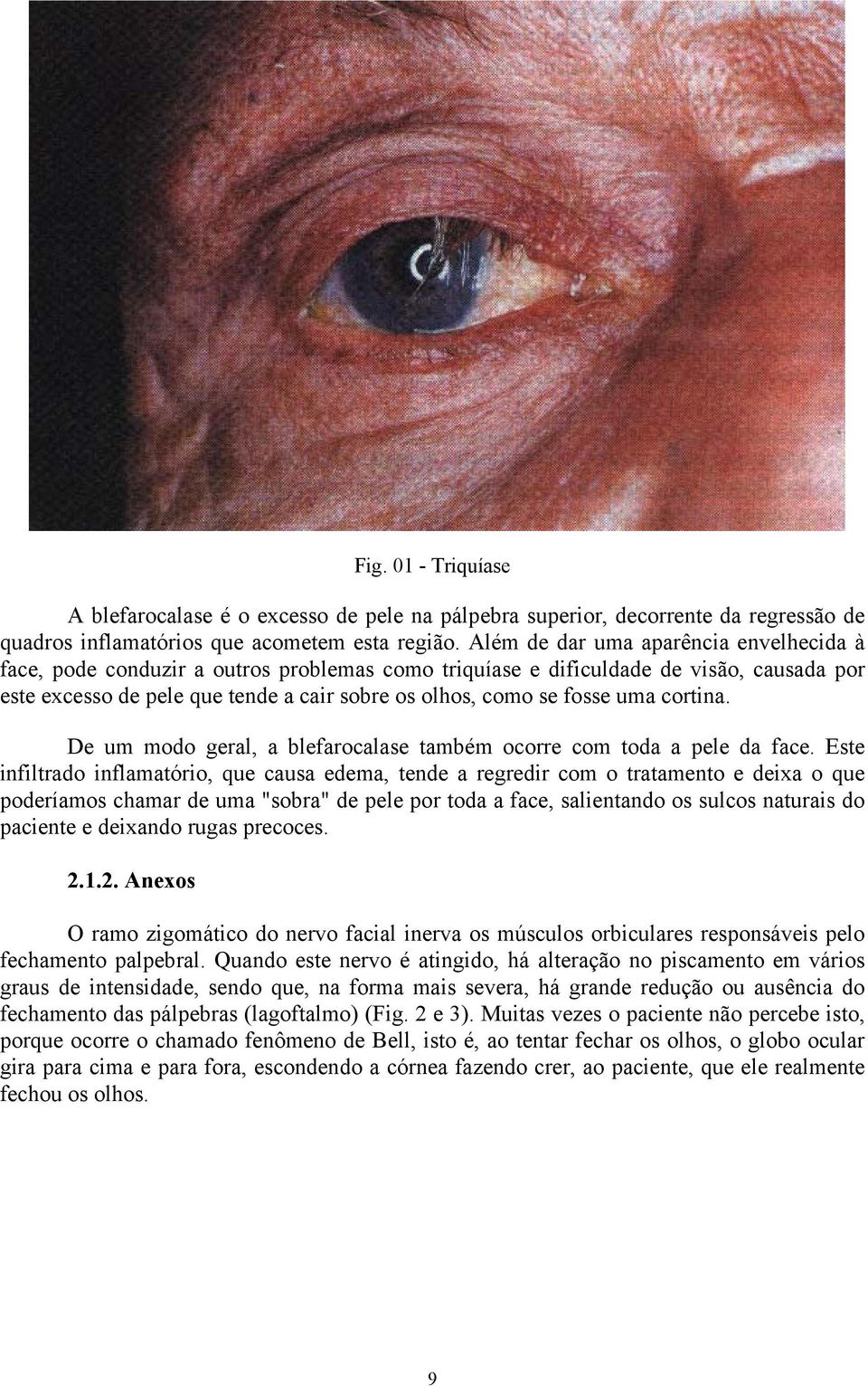 uma cortina. De um modo geral, a blefarocalase também ocorre com toda a pele da face.