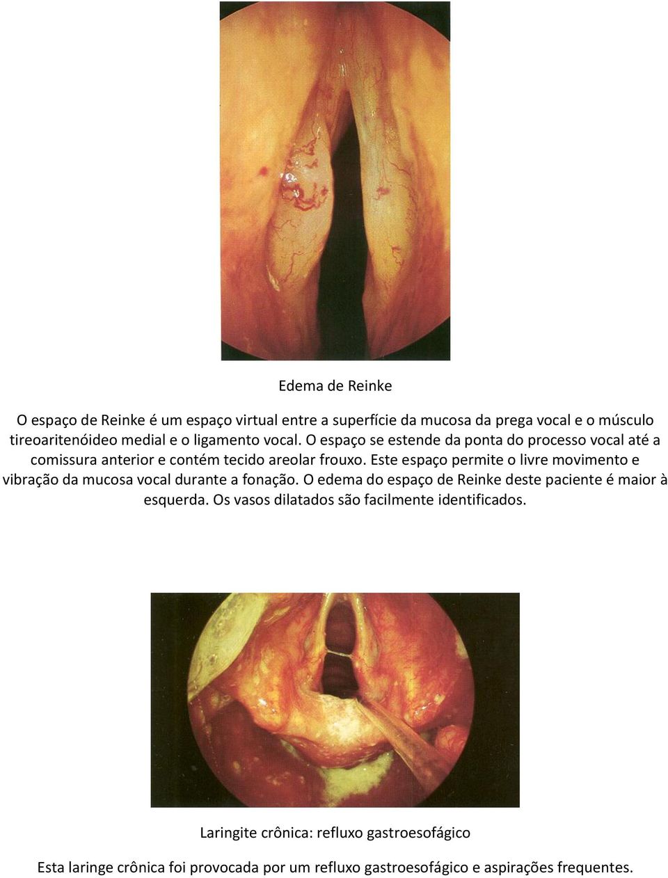 Este espaço permite o livre movimento e vibração da mucosa vocal durante a fonação. O edema do espaço de Reinke deste paciente é maior à esquerda.