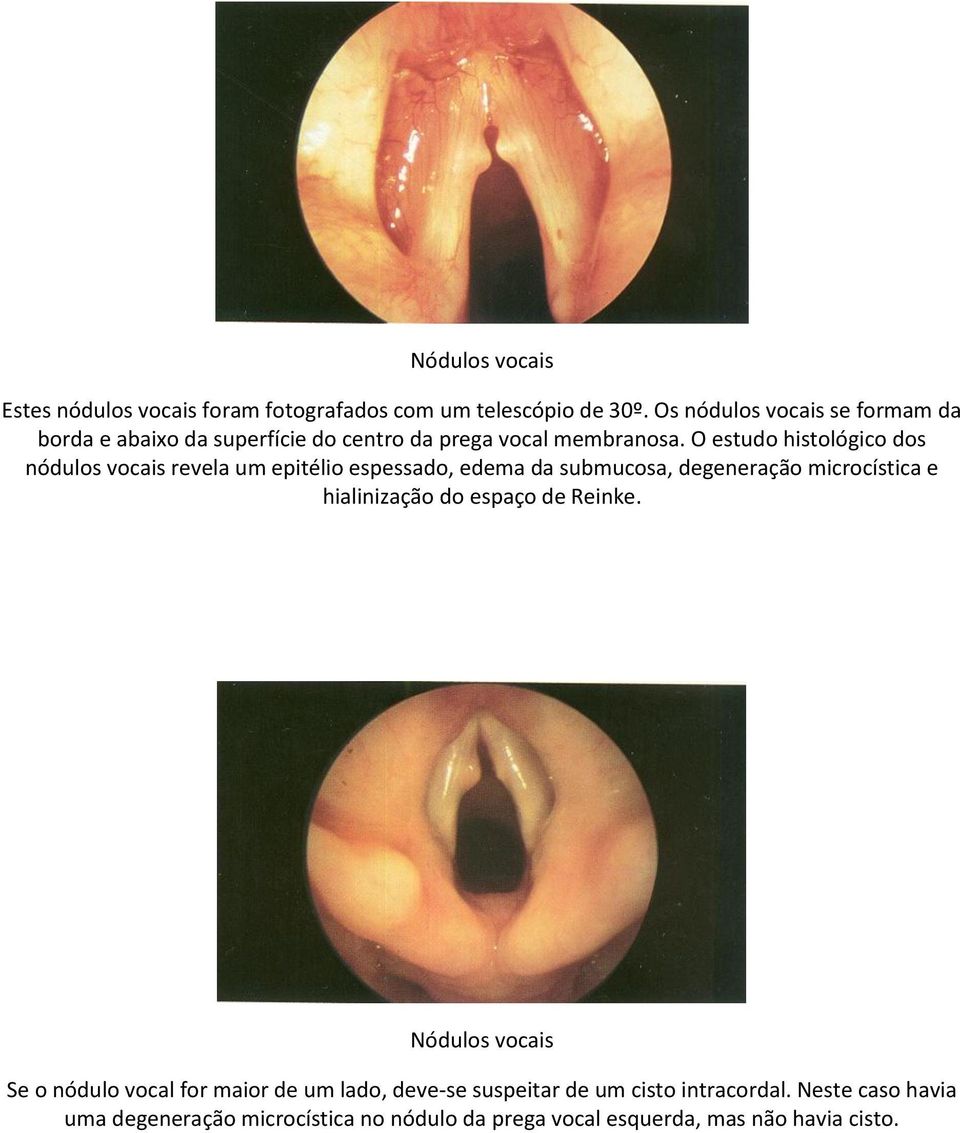 O estudo histológico dos nódulos vocais revela um epitélio espessado, edema da submucosa, degeneração microcística e hialinização