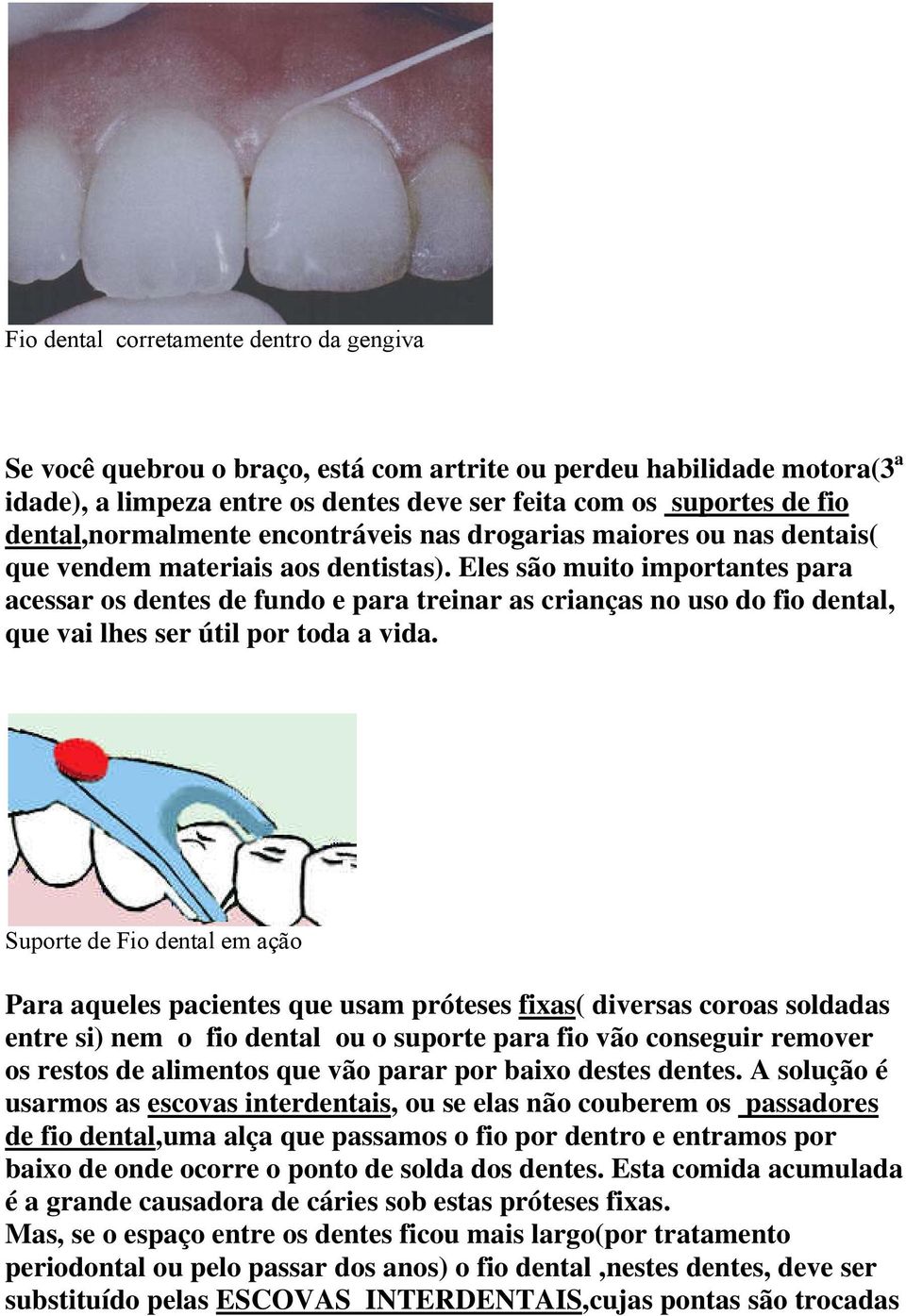 Eles são muito importantes para acessar os dentes de fundo e para treinar as crianças no uso do fio dental, que vai lhes ser útil por toda a vida.