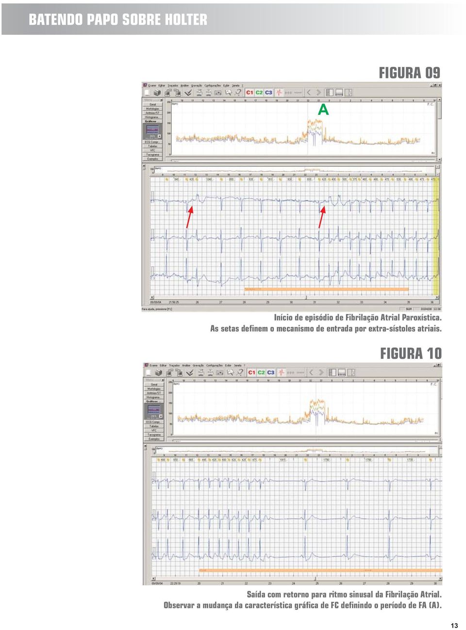 FIGURA 10 Saída com retorno para ritmo sinusal da Fibrilação Atrial.