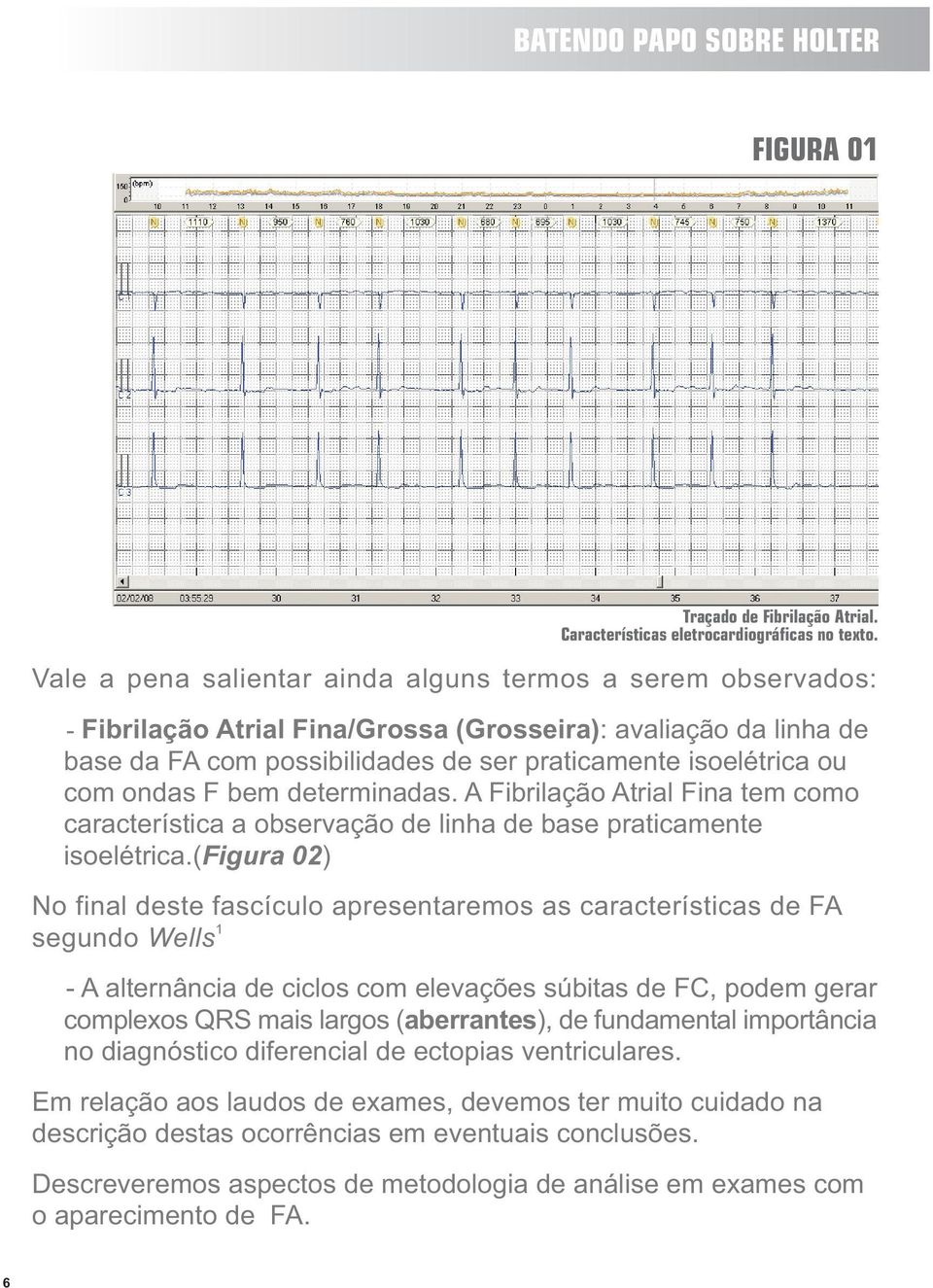 ondas F bem determinadas. A Fibrilação Atrial Fina tem como característica a observação de linha de base praticamente isoelétrica.