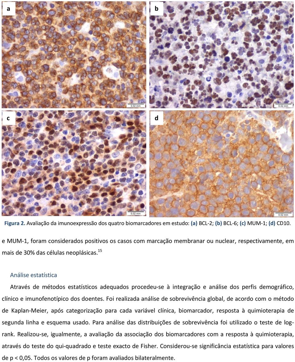 15 Análise estatística Através de métodos estatísticos adequados procedeu-se à integração e análise dos perfis demográfico, clínico e imunofenotípico dos doentes.