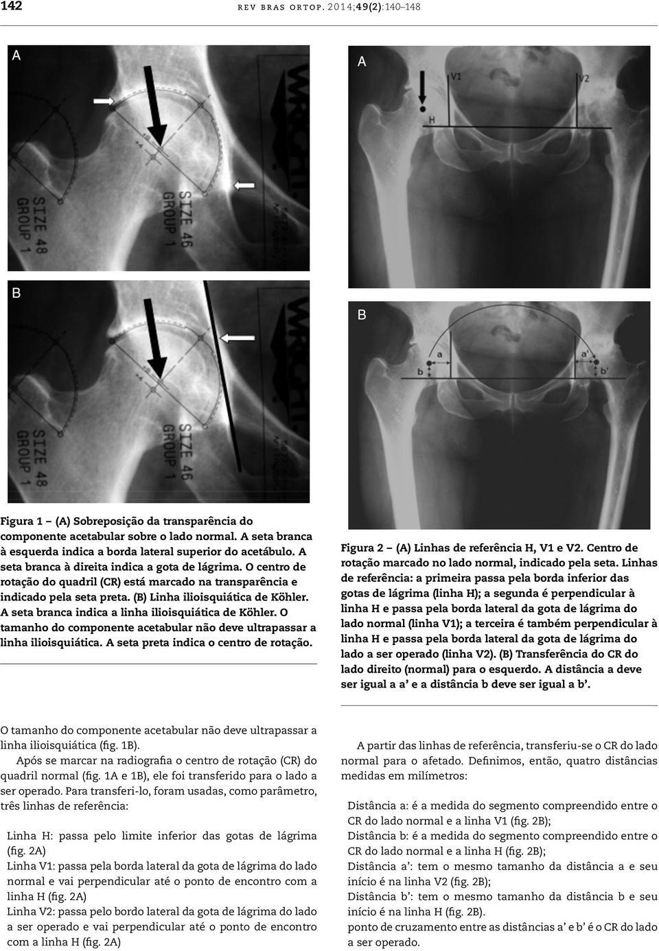 A seta branca indica a linha ilioisquiática de Köhler. O tamanho do componente acetabular não deve ultrapassar a linha ilioisquiática. A seta preta indica o centro de rotação.