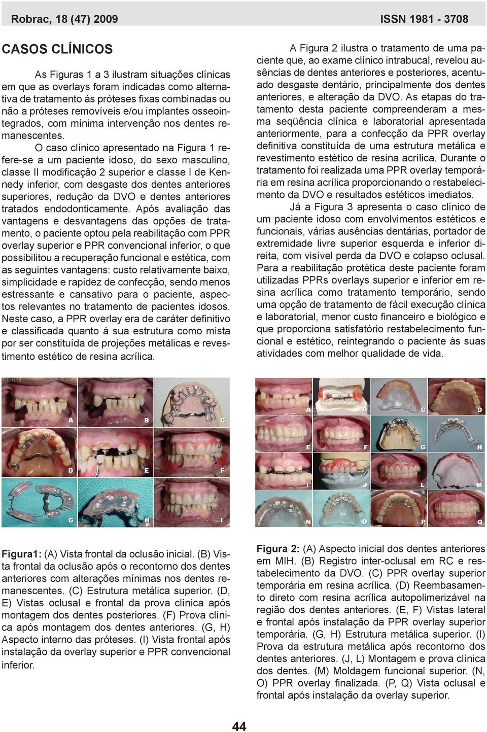 O caso clínico apresentado na Figura 1 refere-se a um paciente idoso, do sexo masculino, classe II modificação 2 superior e classe I de Kennedy inferior, com desgaste dos dentes anteriores
