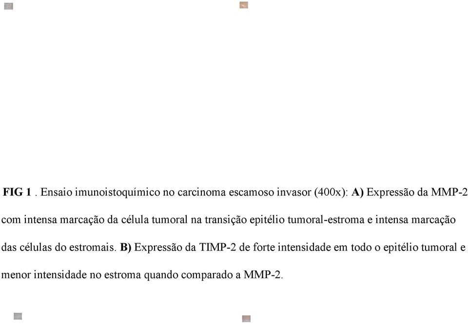 com intensa marcação da célula tumoral na transição epitélio tumoral-estroma e