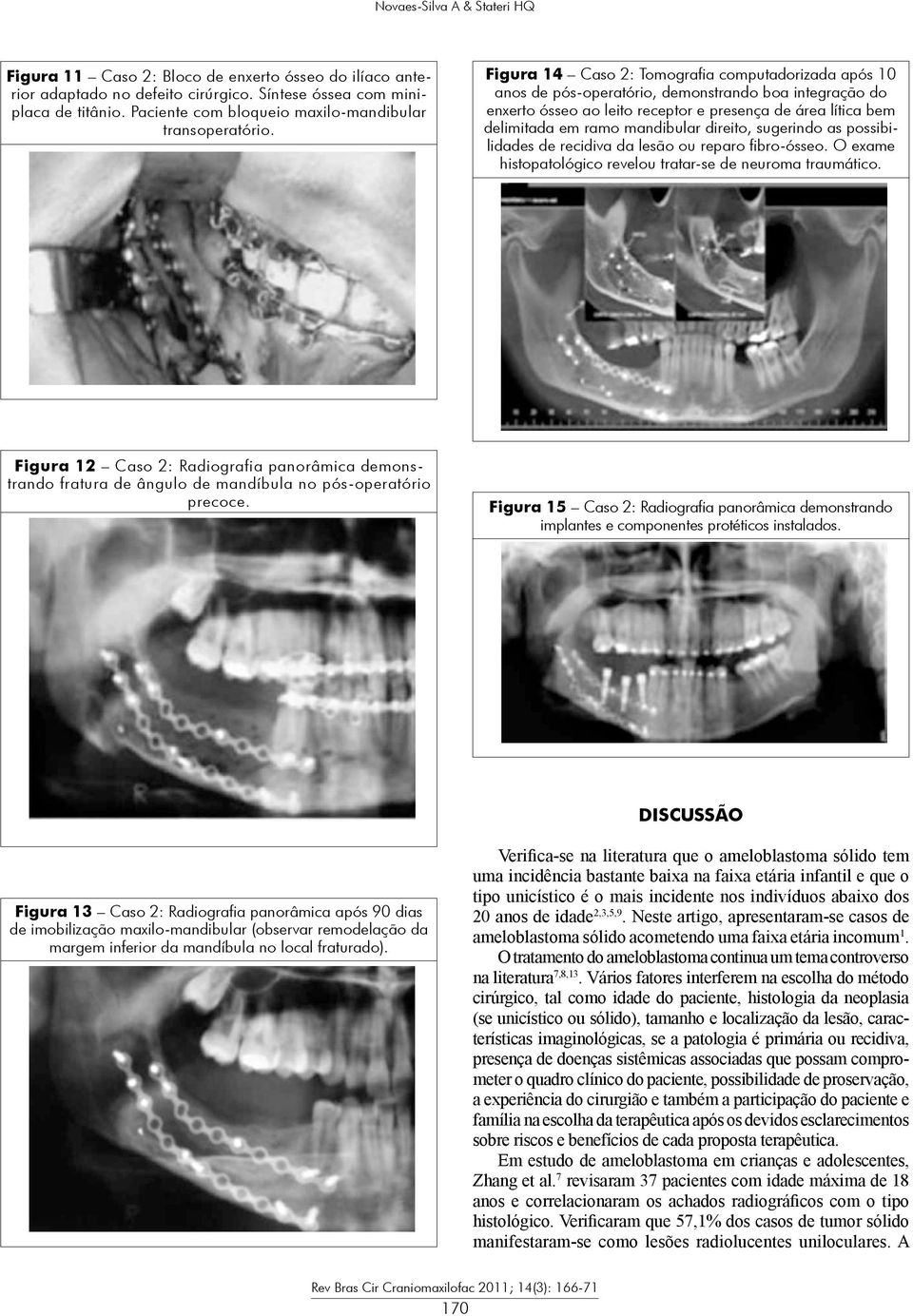 Figura 14 Caso 2: Tomografia computadorizada após 10 anos de pós-operatório, demonstrando boa integração do enxerto ósseo ao leito receptor e presença de área lítica bem delimitada em ramo mandibular