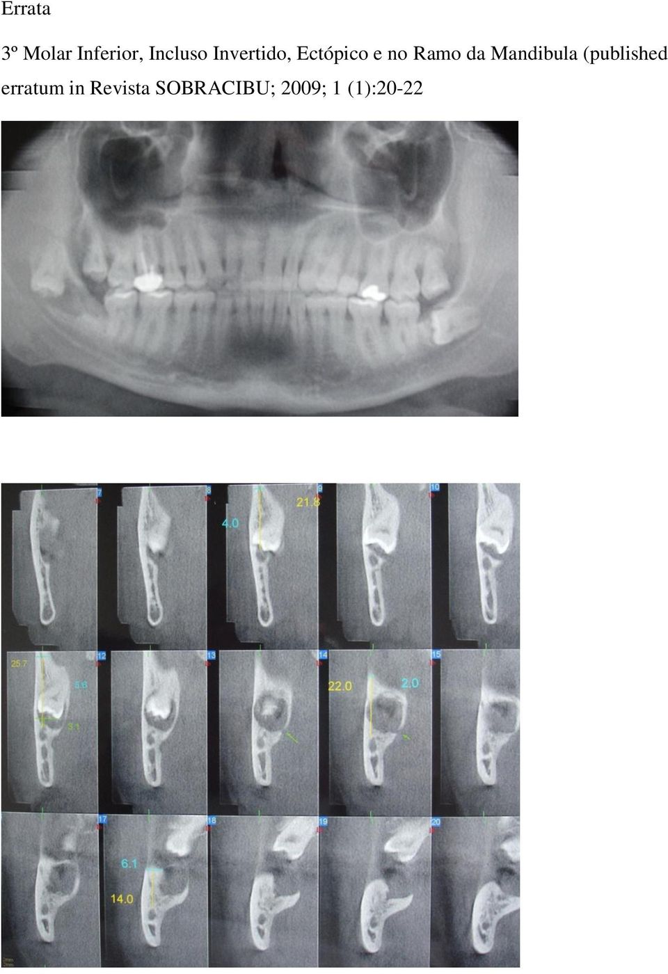 Mandibula (published erratum in