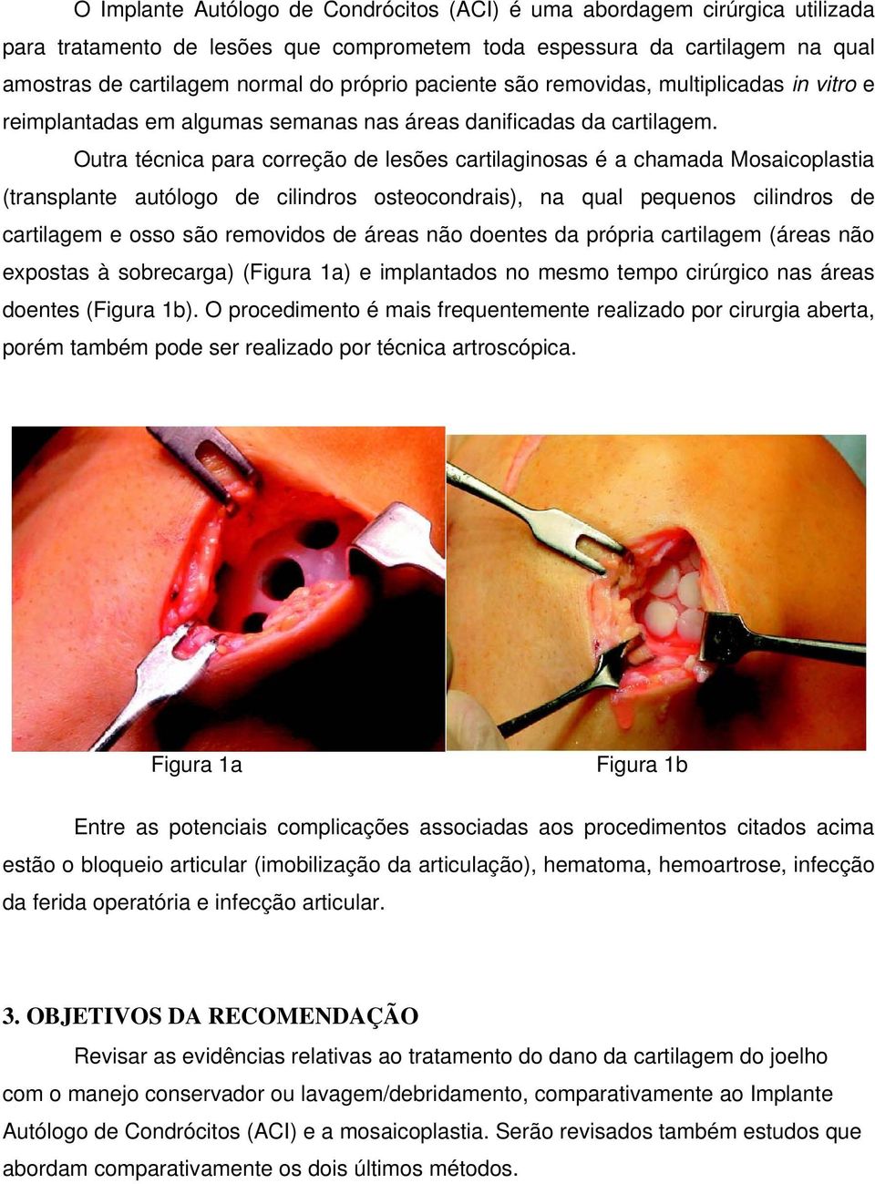 Outra técnica para correção de lesões cartilaginosas é a chamada Mosaicoplastia (transplante autólogo de cilindros osteocondrais), na qual pequenos cilindros de cartilagem e osso são removidos de