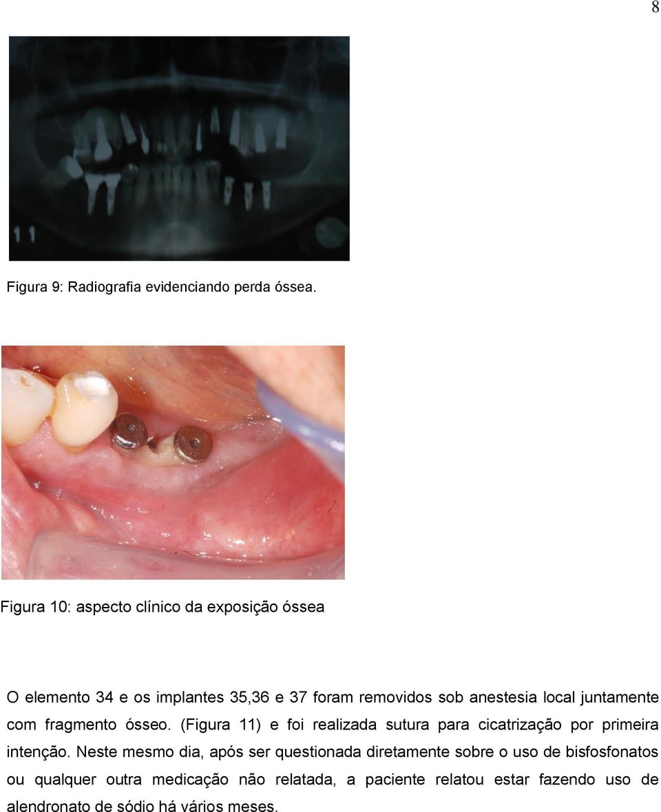 local juntamente com fragmento ósseo. (Figura 11) e foi realizada sutura para cicatrização por primeira intenção.