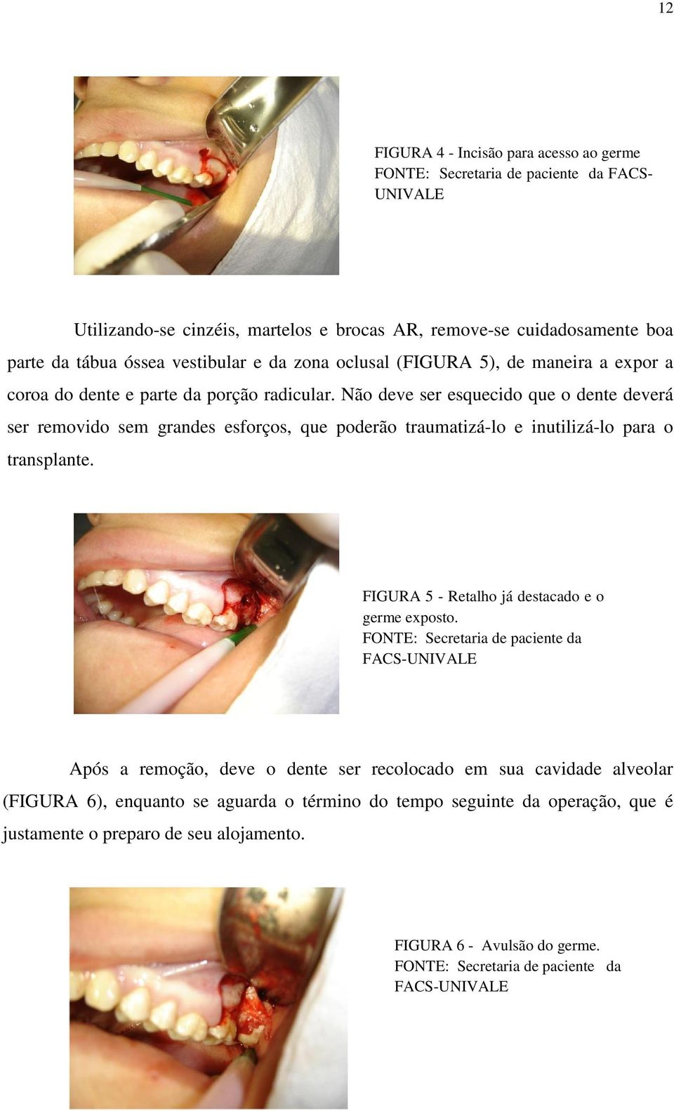 Não deve ser esquecido que o dente deverá ser removido sem grandes esforços, que poderão traumatizá-lo e inutilizá-lo para o transplante. FIGURA 5 - Retalho já destacado e o germe exposto.