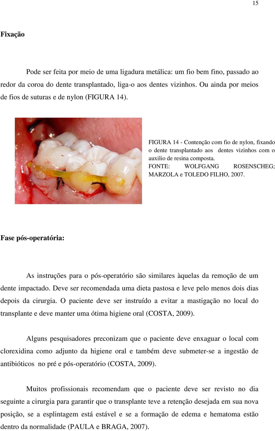 FONTE: WOLFGANG ROSENSCHEG; MARZOLA e TOLEDO FILHO, 2007. Fase pós-operatória: As instruções para o pós-operatório são similares àquelas da remoção de um dente impactado.