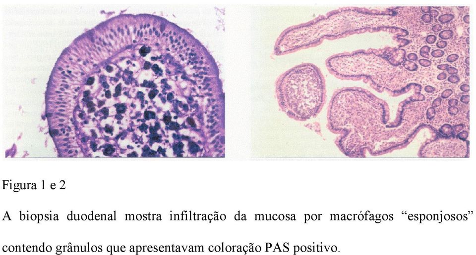 macrófagos esponjosos contendo