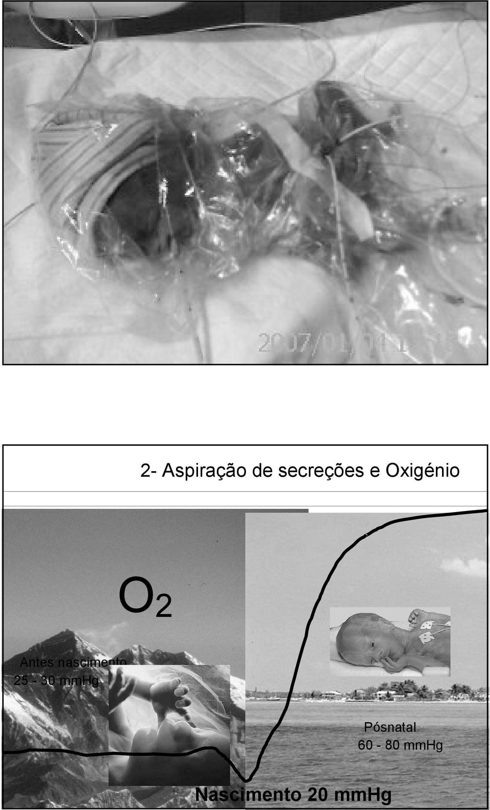 nascimento 25-30 mmhg