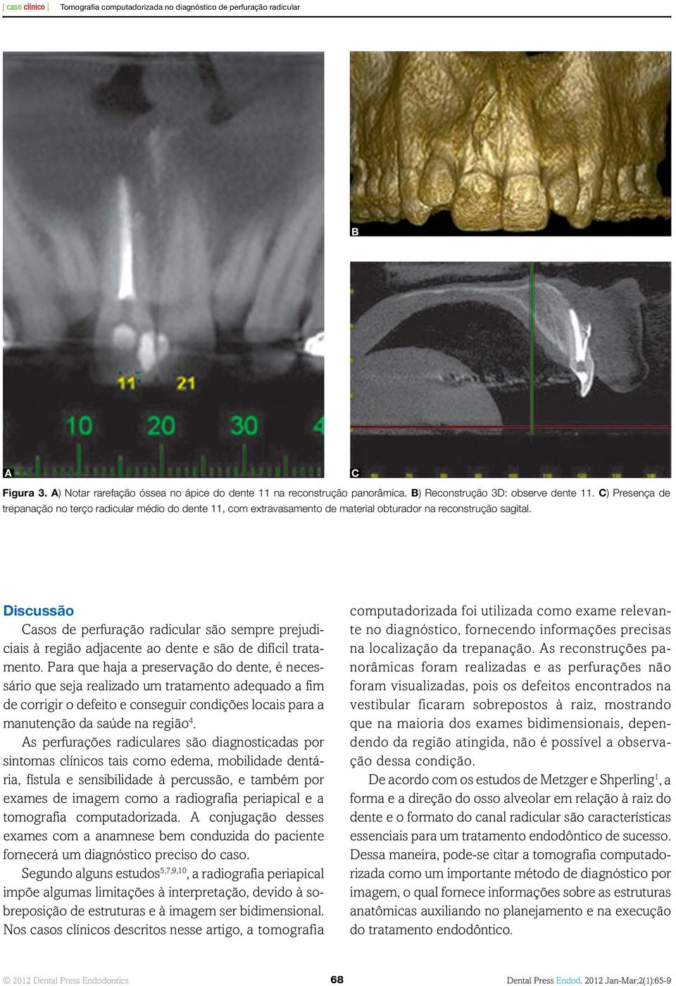 Discussão Casos de perfuração radicular são sempre prejudiciais à região adjacente ao dente e são de difícil tratamento.