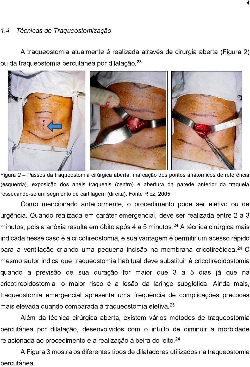 ressecando-se um segmento de cartilagem (direita). Fonte Ricz, 2005. Como mencionado anteriormente, o procedimento pode ser eletivo ou de urgência.