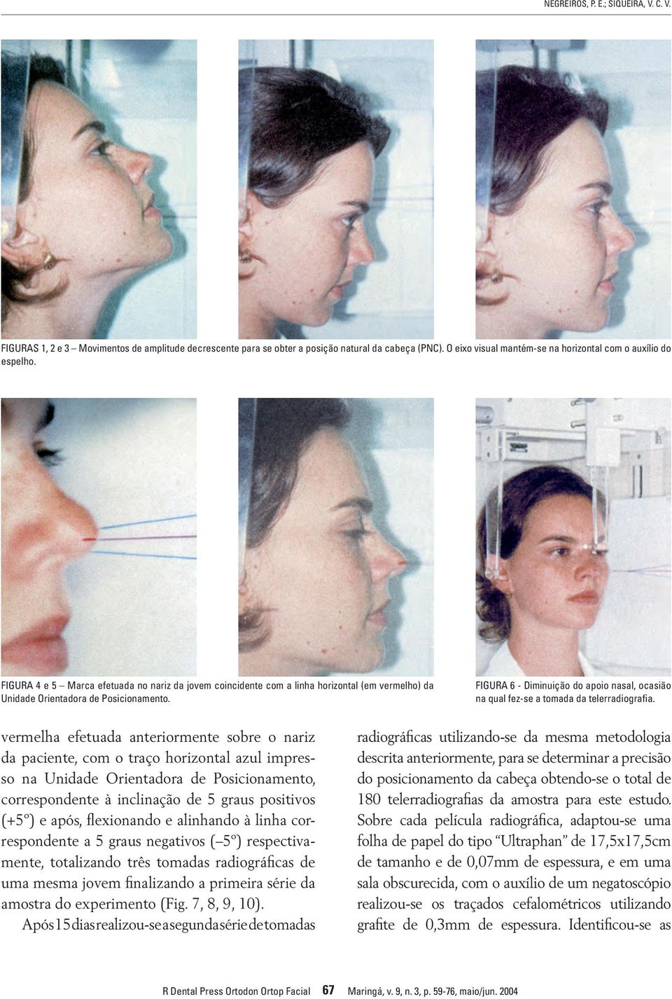 Figura 6 - Diminuição do apoio nasal, ocasião na qual fez-se a tomada da telerradiografia.