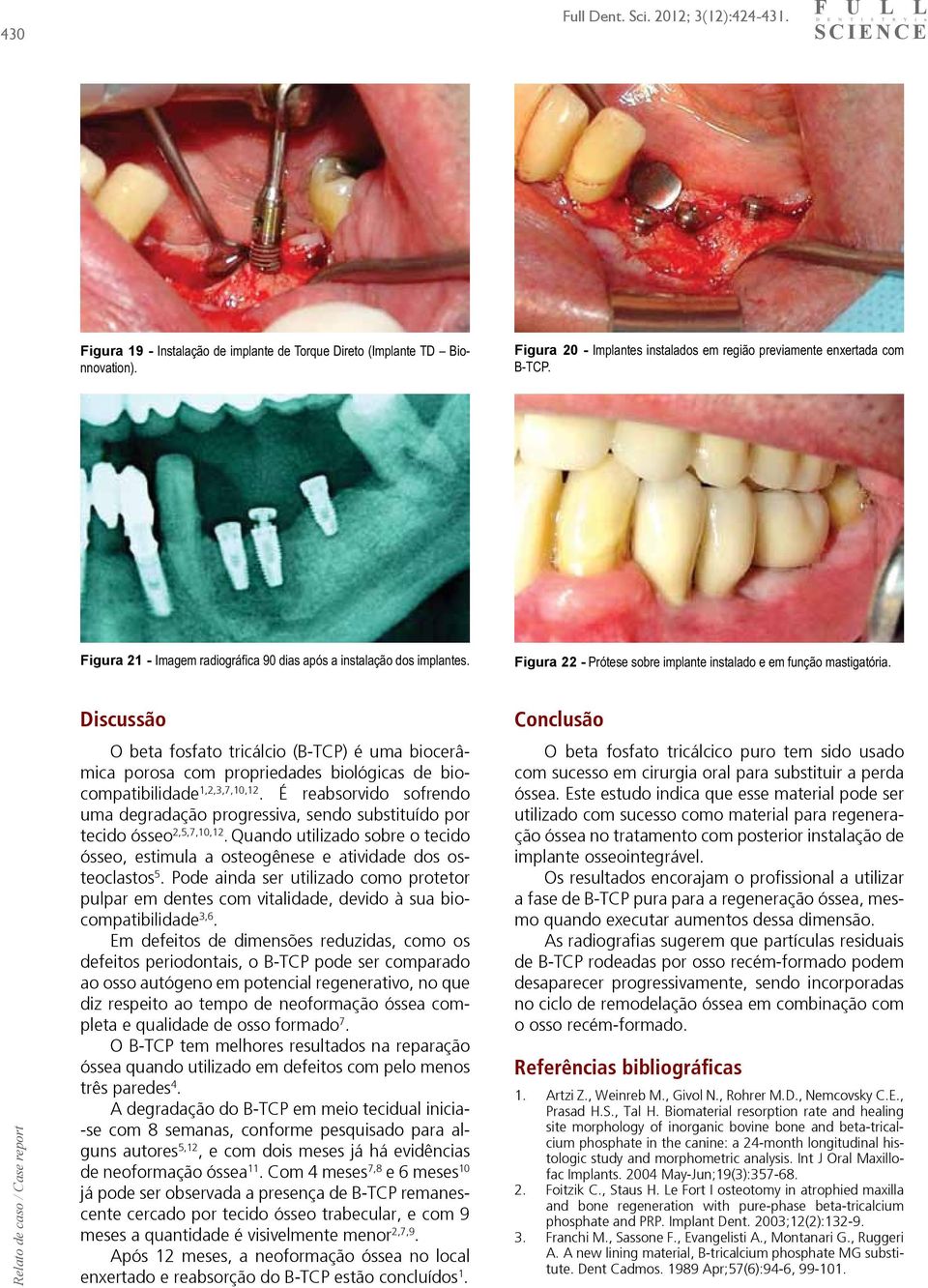 Relato de caso / Case report Discussão O beta fosfato tricálcio (B-TCP) é uma biocerâmica porosa com propriedades biológicas de biocompatibilidade 1,2,3,7,10,12.