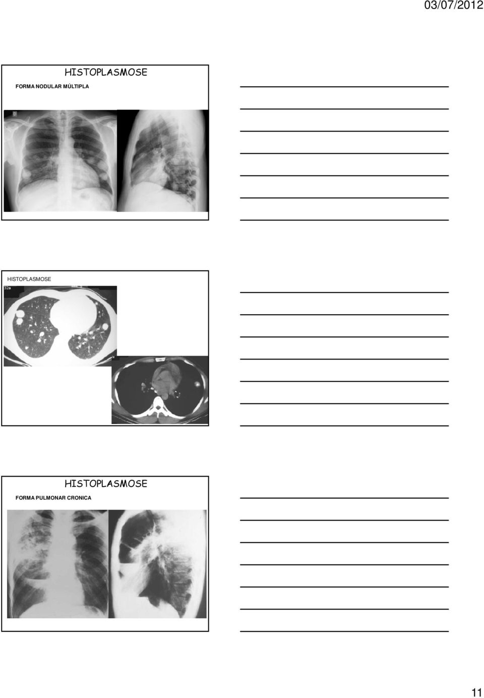 FORMA PULMONAR CRONICA