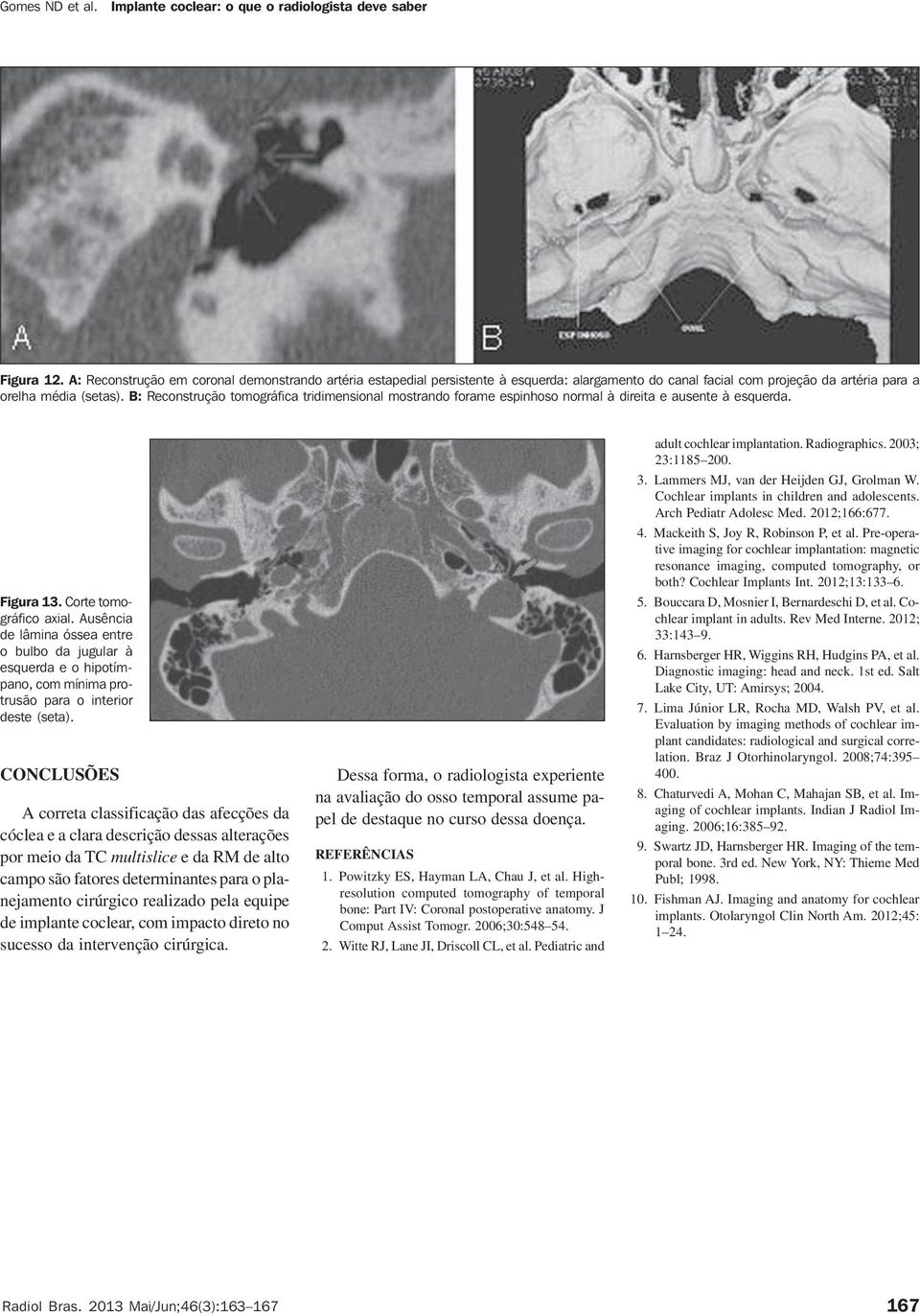 Ausência de lâmina óssea entre o bulbo da jugular à esquerda e o hipotímpano, com mínima protrusão para o interior deste (seta).