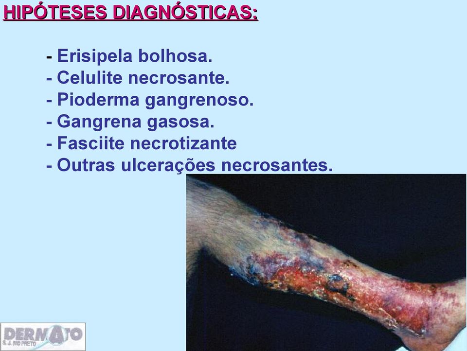 - Pioderma gangrenoso. - Gangrena gasosa.