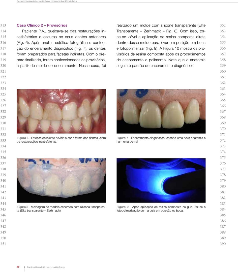 Com isso, tor- 353 315 satisfatórias e escuras no seus dentes anteriores na-se viável a aplicação de resina composta direta 354 316 (Fig. 6).