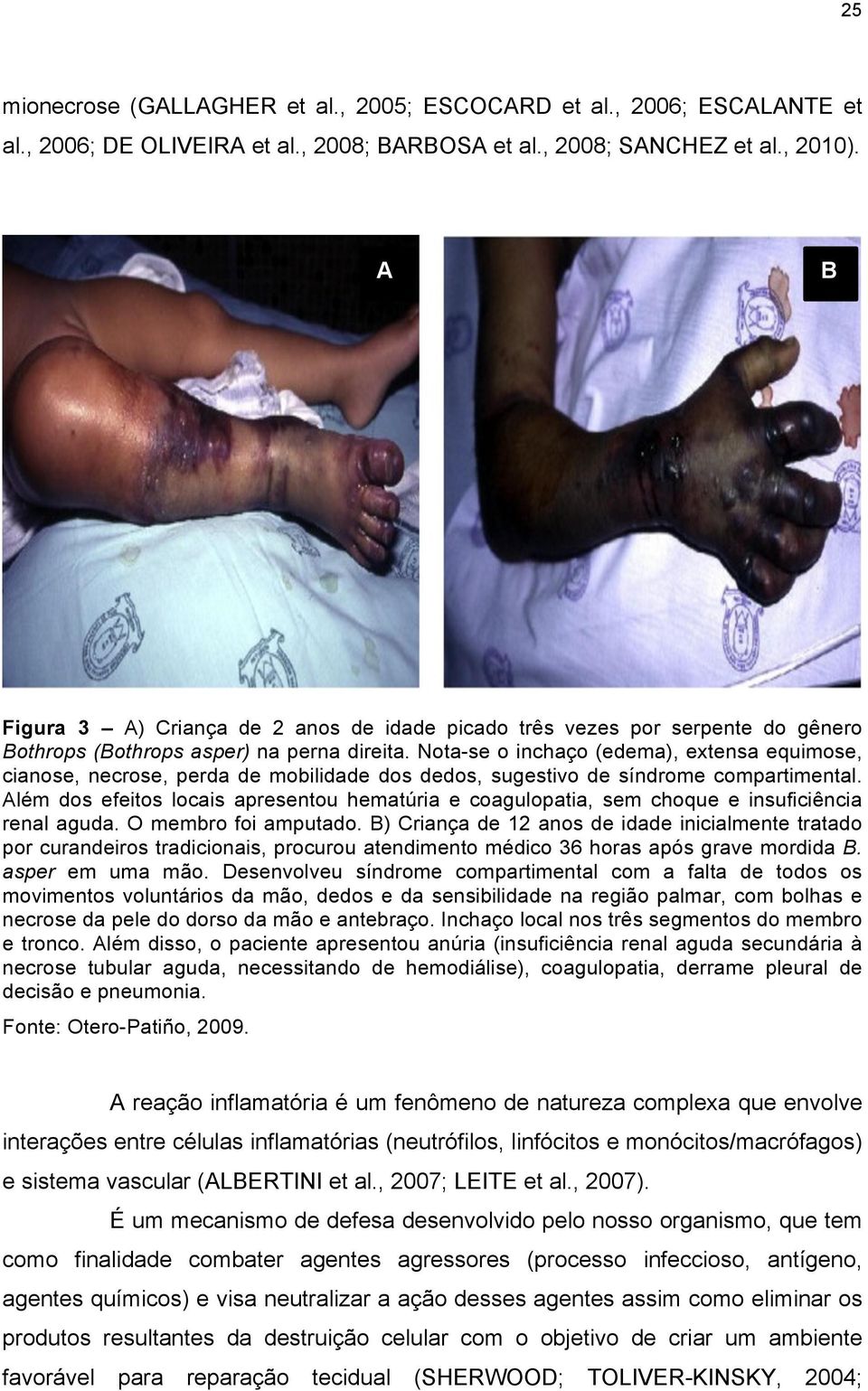 Nota-se o inchaço (edema), extensa equimose, cianose, necrose, perda de mobilidade dos dedos, sugestivo de síndrome compartimental.