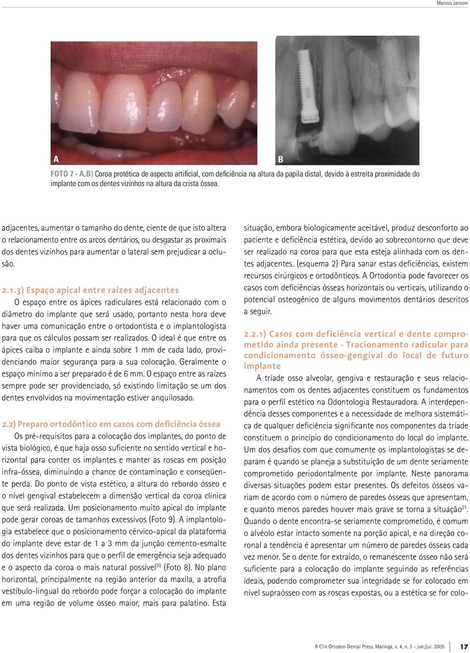 B adjacentes, aumentar o tamanho do dente, ciente de que isto altera o relacionamento entre os arcos dentários, ou desgastar as proximais dos dentes vizinhos para aumentar o lateral sem prejudicar a