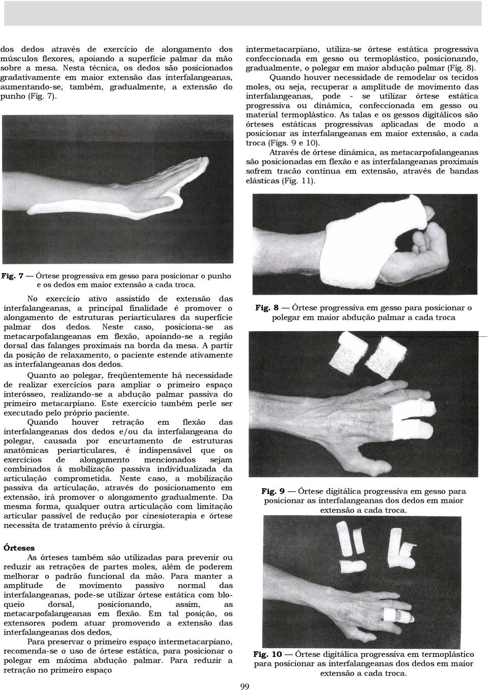 intermetacarpiano, utiliza-se órtese estática progressiva confeccionada em gesso ou termoplástico, posicionando, gradualmente, o polegar em maior abdução palmar (Fig. 8).