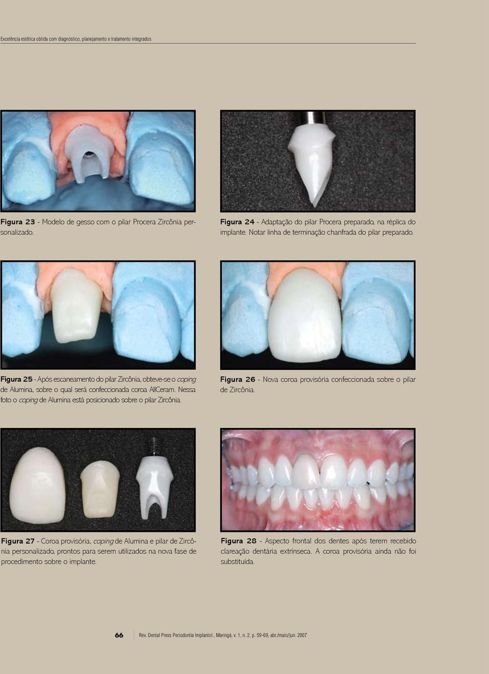 Figura 25 - Após escaneamento do pilar Zircônia, obteve-se o coping de Alumina, sobre o qual será confeccionada coroa AllCeram. Nessa foto o coping de Alumina está posicionado sobre o pilar Zircônia.