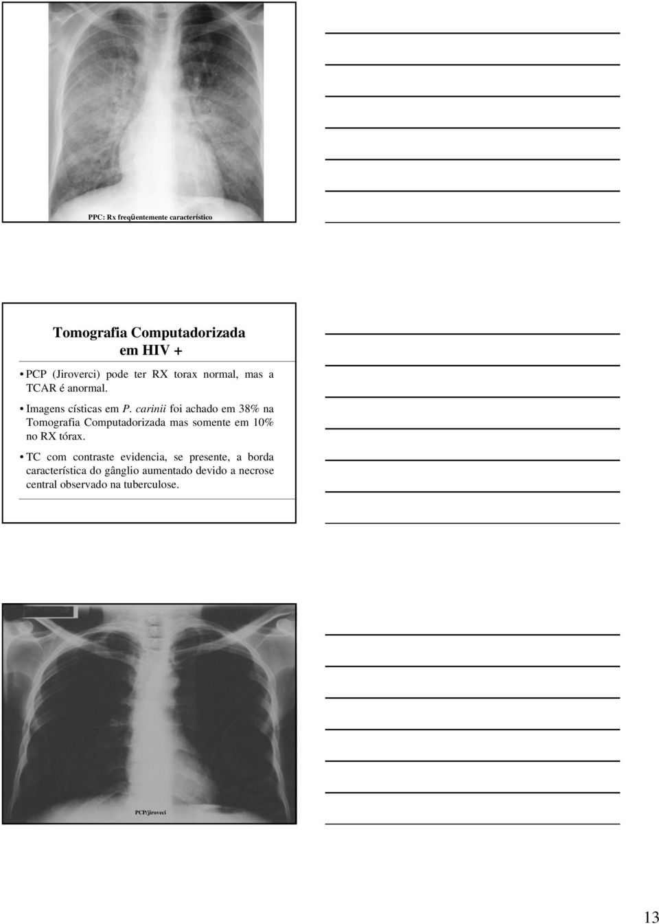 carinii foi achado em 38% na Tomografia Computadorizada mas somente em 10% no RX tórax.