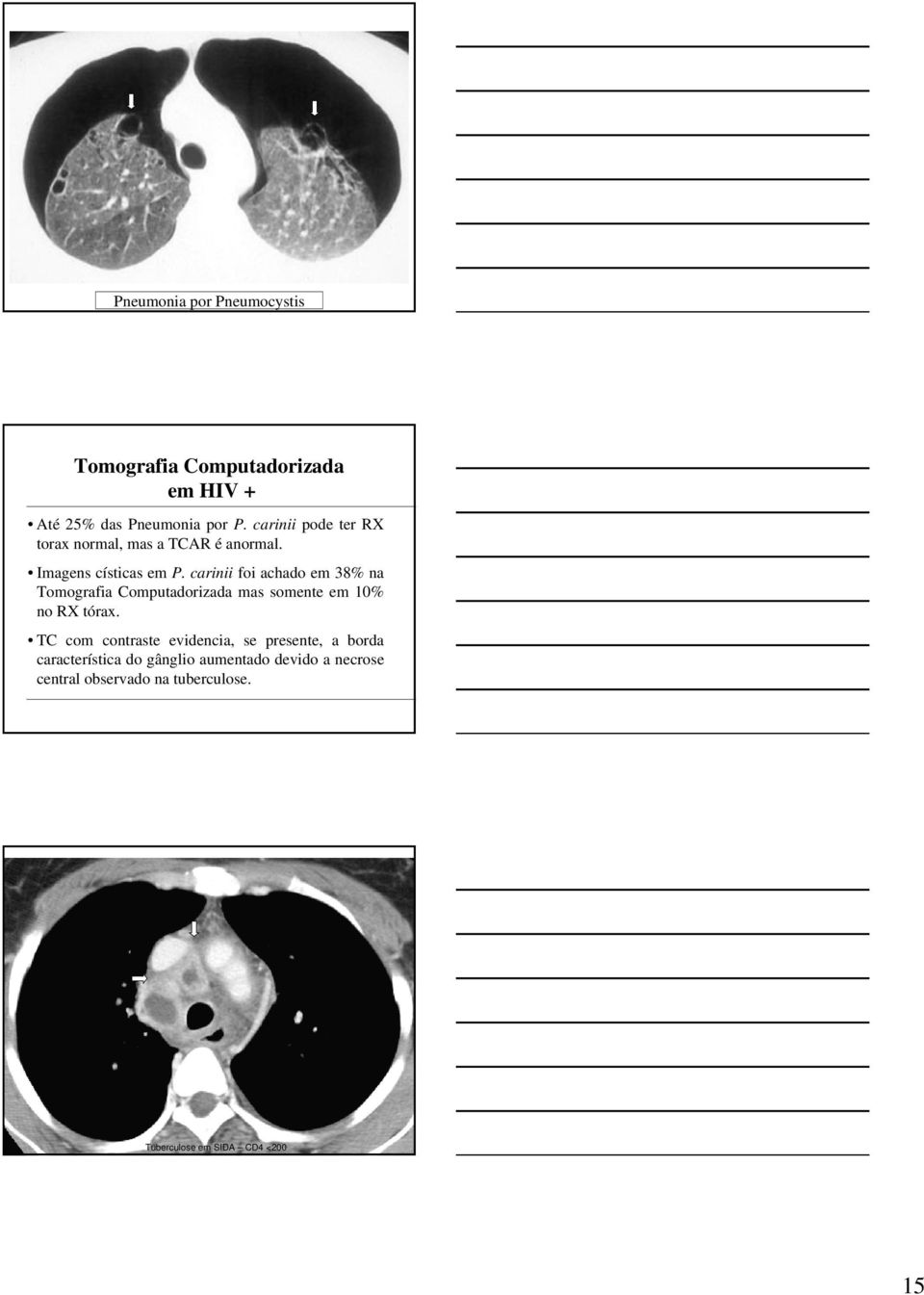 carinii foi achado em 38% na Tomografia Computadorizada mas somente em 10% no RX tórax.