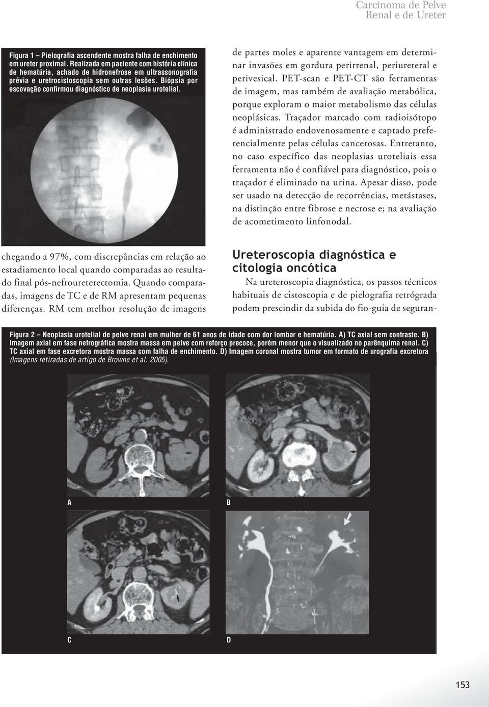 Biópsia por escovação confirmou diagnóstico de neoplasia urotelial. de partes moles e aparente vantagem em determinar invasões em gordura perirrenal, periureteral e perivesical.