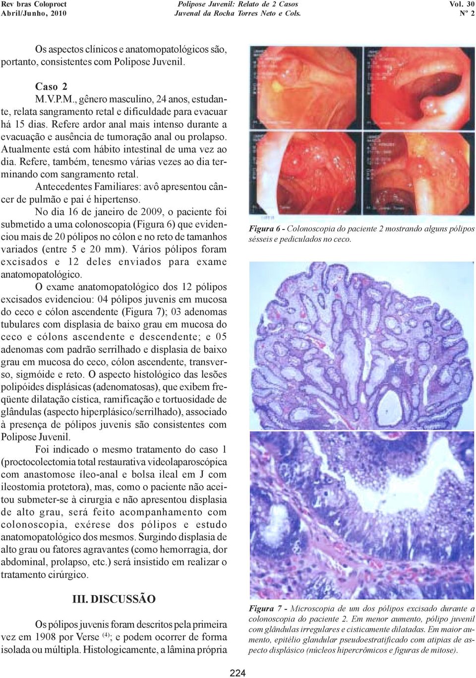 Refere ardor anal mais intenso durante a evacuação e ausência de tumoração anal ou prolapso. Atualmente está com hábito intestinal de uma vez ao dia.