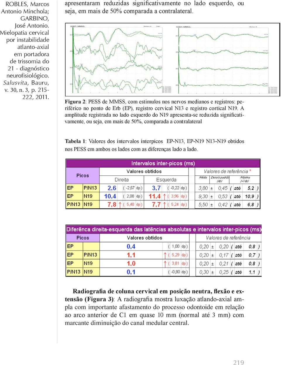 A amplitude registrada no lado esquerdo do N19 apresenta-se reduzida significativamente, ou seja, em mais de 50%, comparada a contralateral Tabela 1: Valores dos intervalos interpicos EP-N13, EP-N19