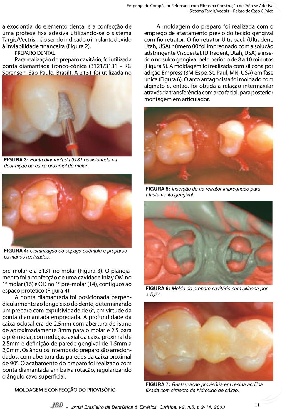 PREPARO DENTAL Para realização do preparo cavitário, foi utilizada ponta diamantada tronco-cônica (3121/3131 KG Sorensen, São Paulo, Brasil).