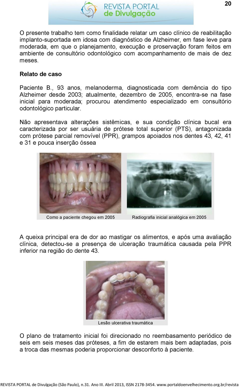 , 93 anos, melanoderma, diagnosticada com demência do tipo Alzheimer desde 2003; atualmente, dezembro de 2005, encontra-se na fase inicial para moderada; procurou atendimento especializado em