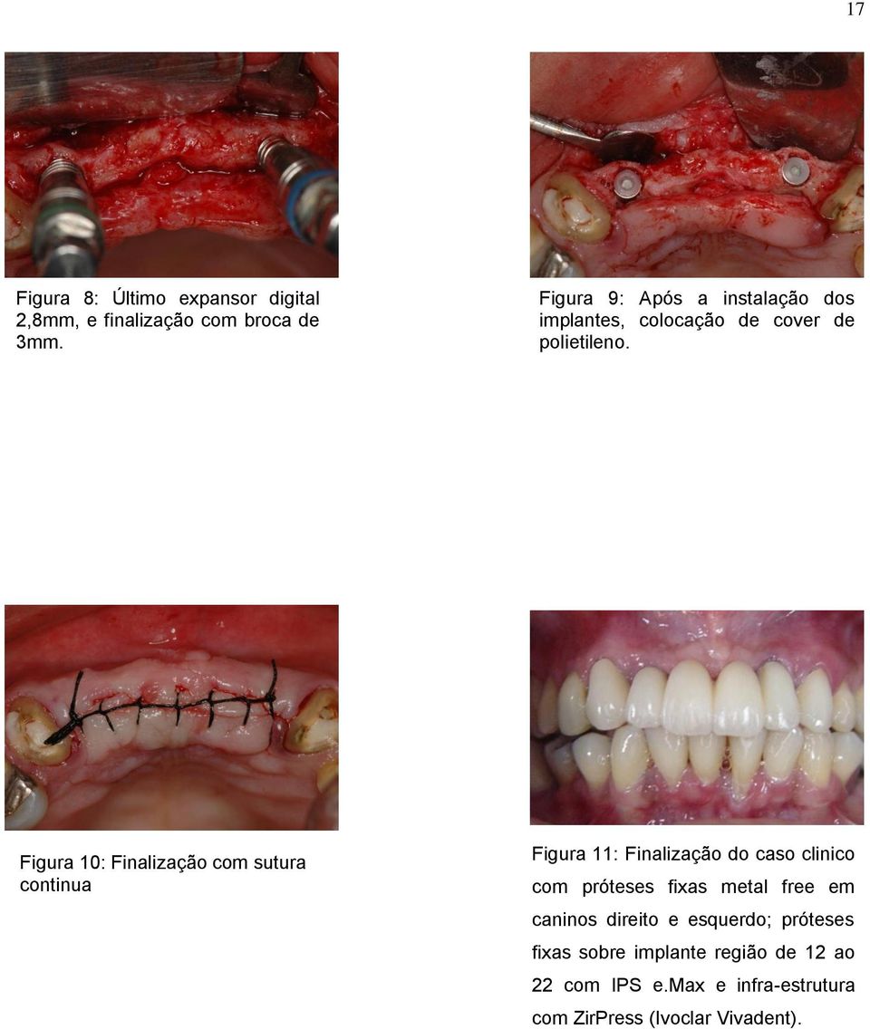 Figura 10: Finalização com sutura continua Figura 11: Finalização do caso clinico com próteses fixas