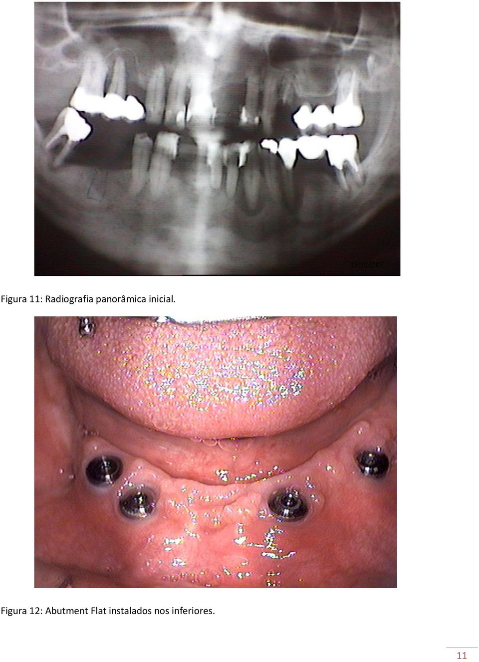 Figura 12: Abutment Flat