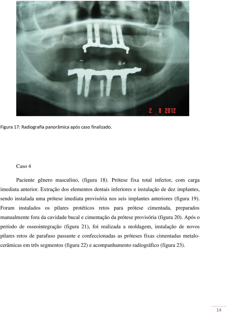 Foram instalados os pilares protéticos retos para prótese cimentada, preparados manualmente fora da cavidade bucal e cimentação da prótese provisória (figura 20).