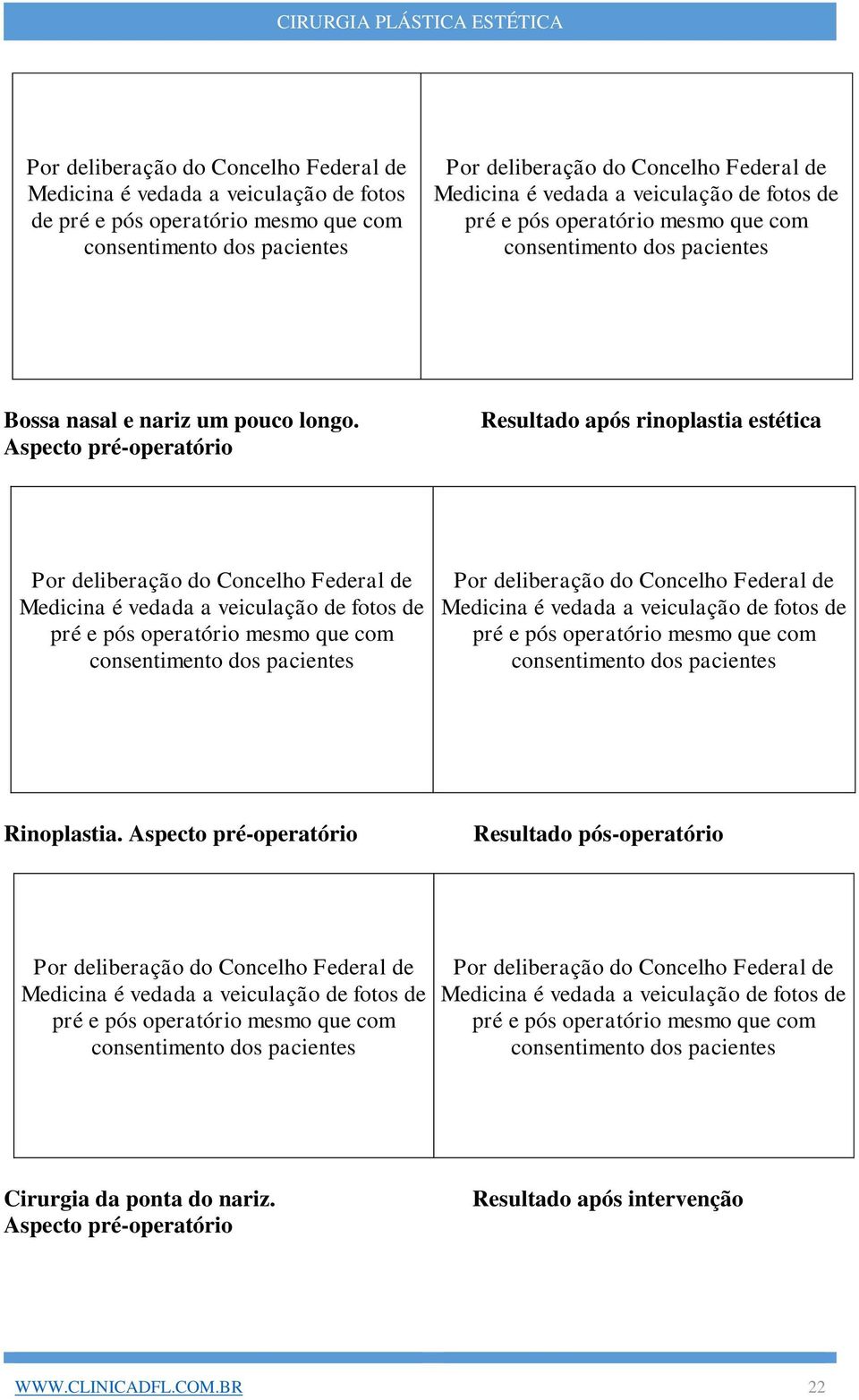 Aspecto pré-operatório Resultado após rinoplastia estética Rinoplastia.