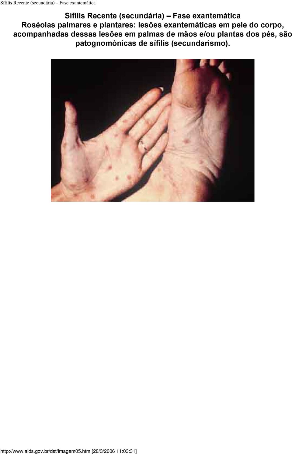 acompanhadas dessas lesões em palmas de mãos e/ou plantas dos pés, são