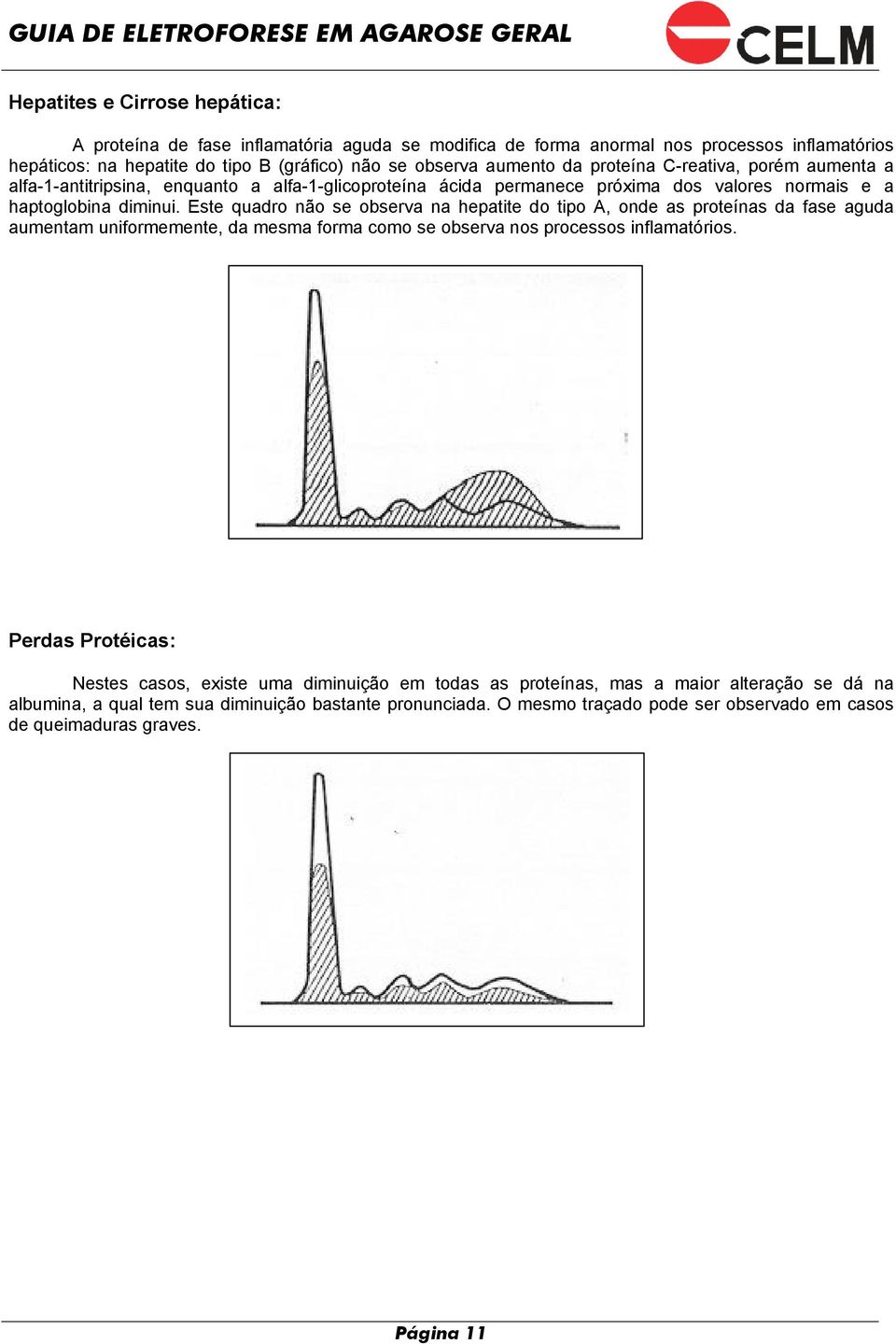 Este quadro não se observa na hepatite do tipo A, onde as proteínas da fase aguda aumentam uniformemente, da mesma forma como se observa nos processos inflamatórios.