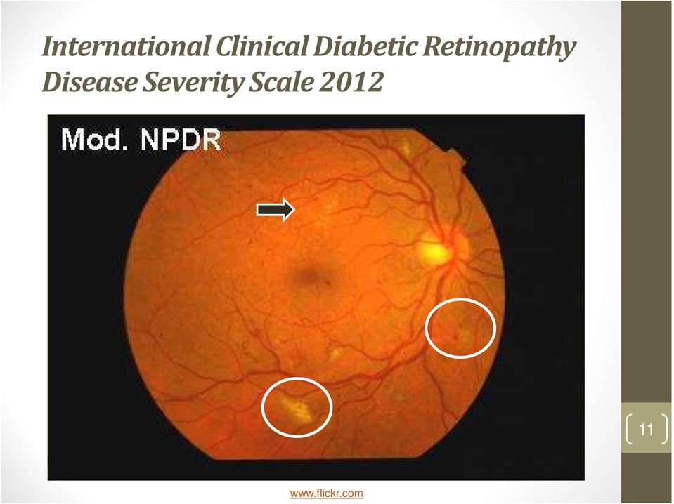 Disease Severity Scale